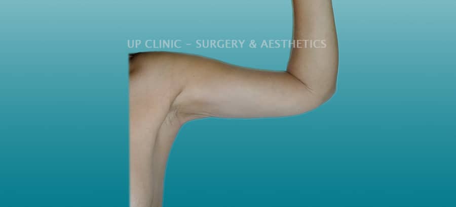 Lipo depois braços up clinic