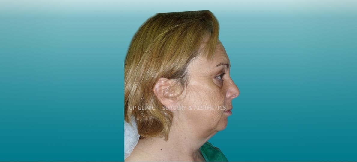 facelift lipoestaminal antes e depois up clinic