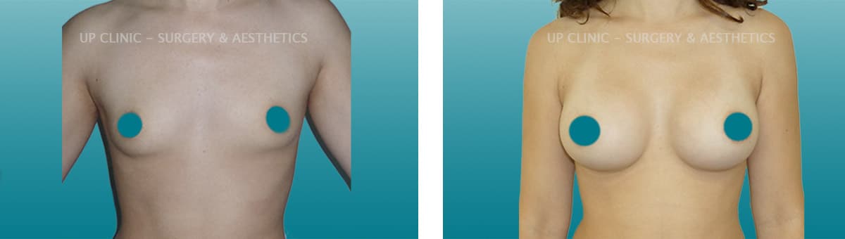 Mamoplastia de aumento antes e depois up clinic