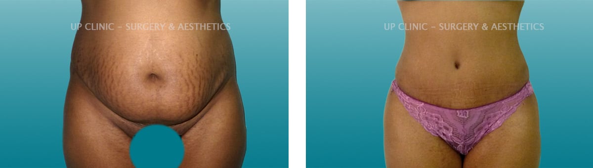 Lipoabdominoplastia antes e depois up clinic
