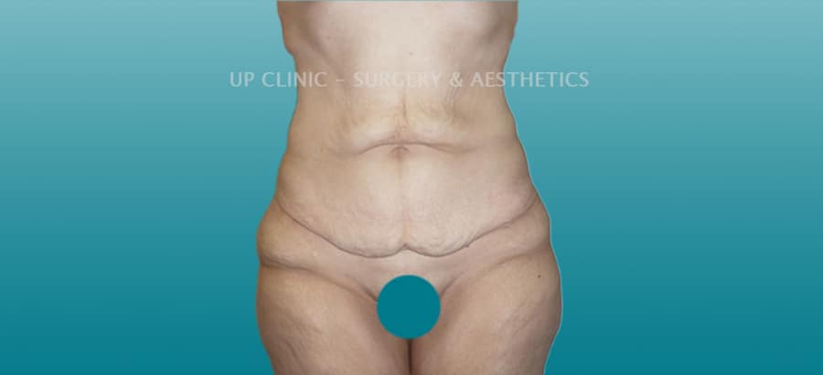 Abdominoplastia antes