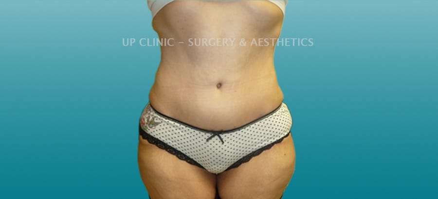 Abdominoplastia Up Clinic