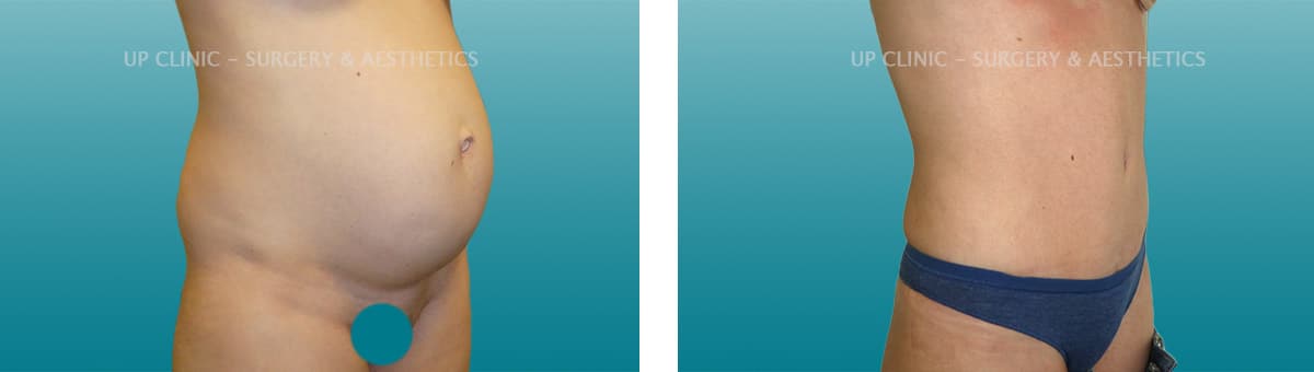 abdominoplastia antes e depois up clinic