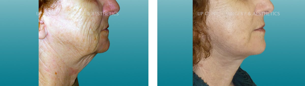 facelift lipoestaminal antes e depois up clinic