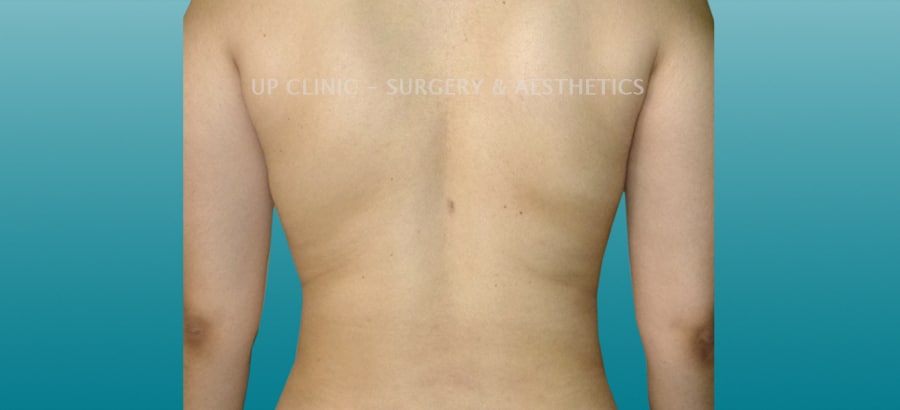 Lipo costas depois Up Clinic