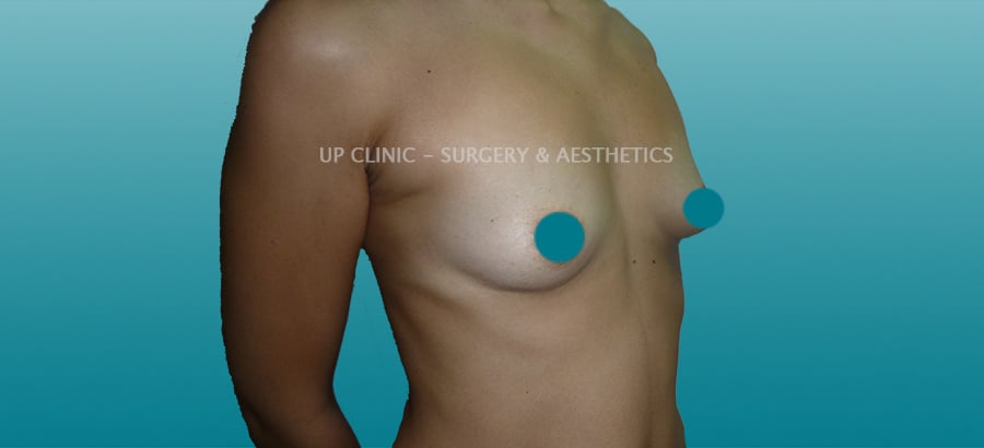 mamoplastia de aumento próteses anatómicas antes depois Up Clinic