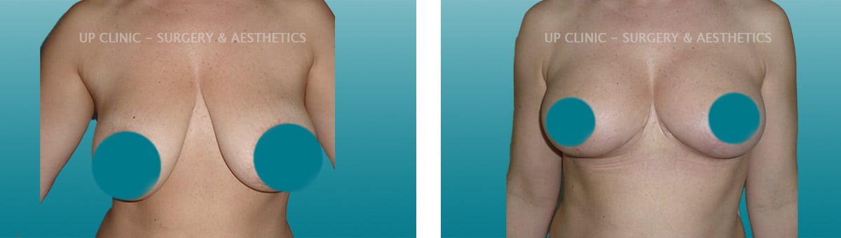Redução mamária antes e depois Up Clinic