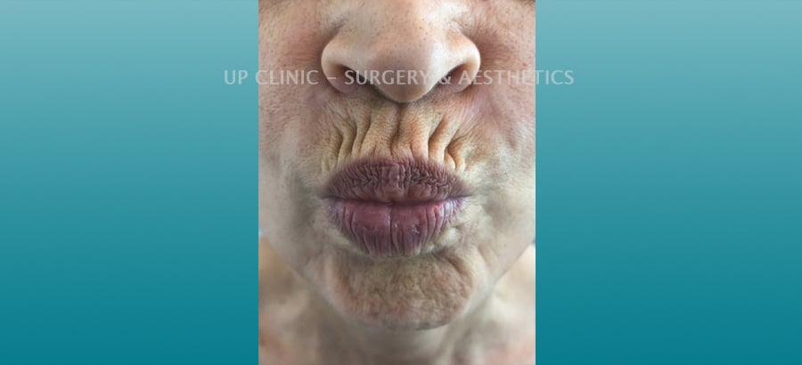 Lábios antes Up Clinic