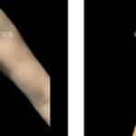 antes e depois mamoplastia de aumento