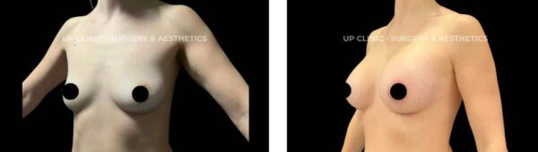 antes e depois mamoplastia de aumento