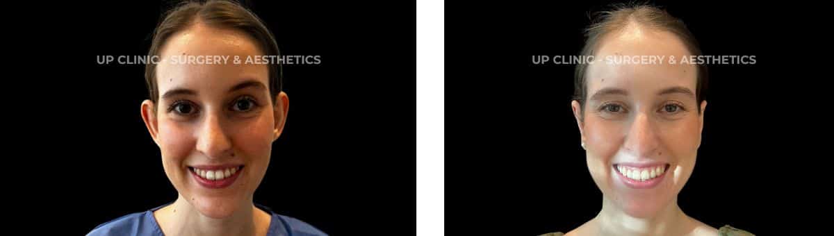 A paciente fez uma otoplastia. O procedimento foi realizado pela Dra. Rita Meireles.