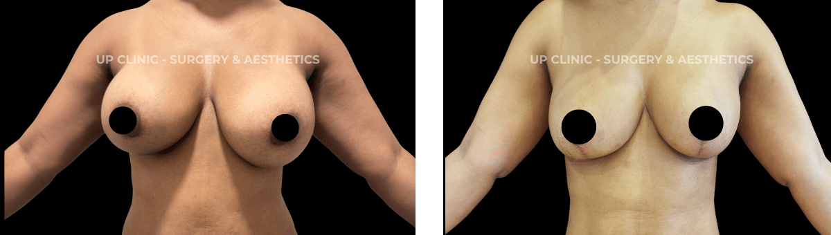 A paciente realizou um explante com lipofilling. O procedimento foi realizado pelo Dr. Rui Lima.