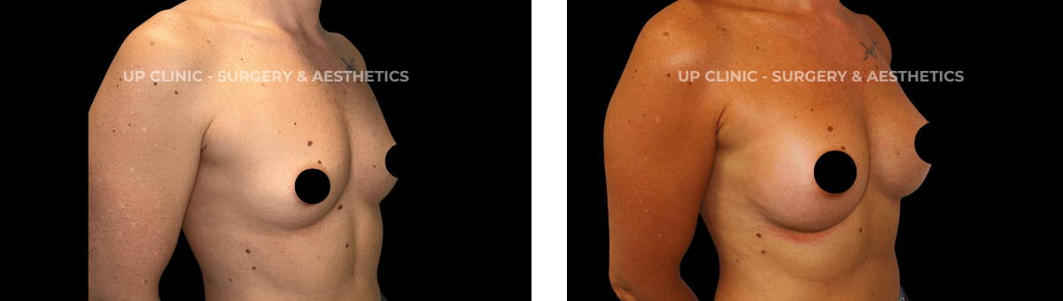 A paciente realizou uma mamoplastia de aumento. Esta cirurgia foi realizada pelo Dr. Tiago Baptista Fernandes.