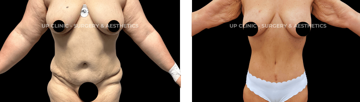 A paciente realizou uma Lipoabdominoplastia Secundária. Esta cirurgia foi realizada pelo Dr. Rui Lima.