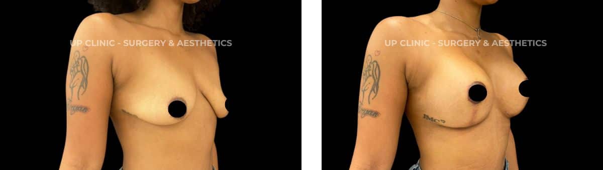 A paciente realizou uma mamoplastia de aumento. Esta cirurgia foi realizada pela Dra. Rita Meireles.