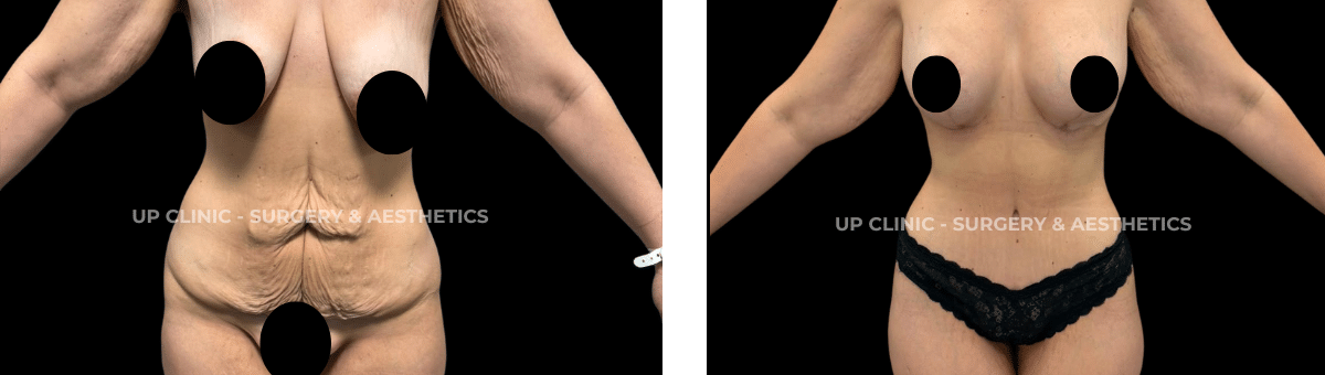 A paciente realizou um Body Lift e Mastopexia de aumento com implante anatómico. Esta cirurgia foi realizada pelo Dr. Rui Lima.
