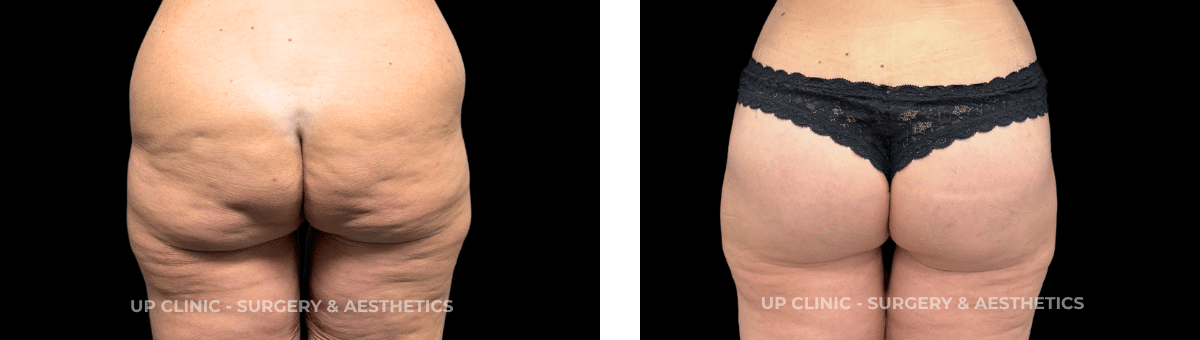 A paciente realizou Mamoplastia de Aumento. Esta cirurgia foi realizada pelo Dr. Rui Lima.